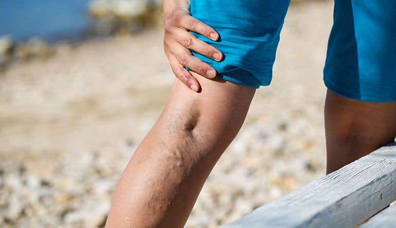 Painful Varicose Veins Treatment and Prevention | VTC Specialist in New York, New Jersey, San Diego