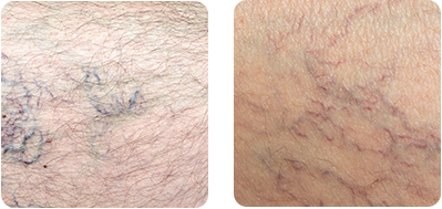 Best varicose vein removal procedure| Vein experts