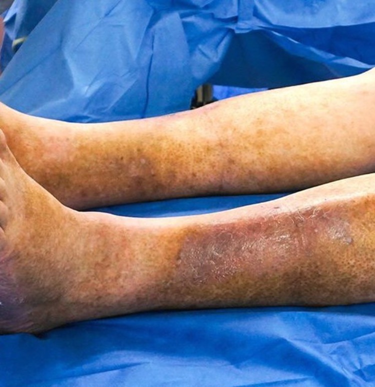 What is Skin Discoloration on Legs Telling You? | Harvard Trained Doctor