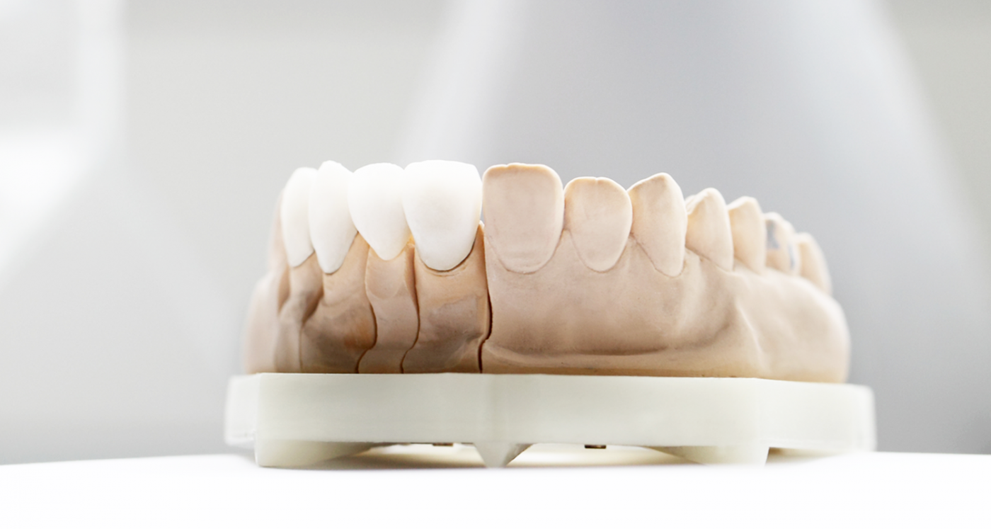 Veneer Cost & Benefits | Uptown Dentist in Houston TX | URBN Dental