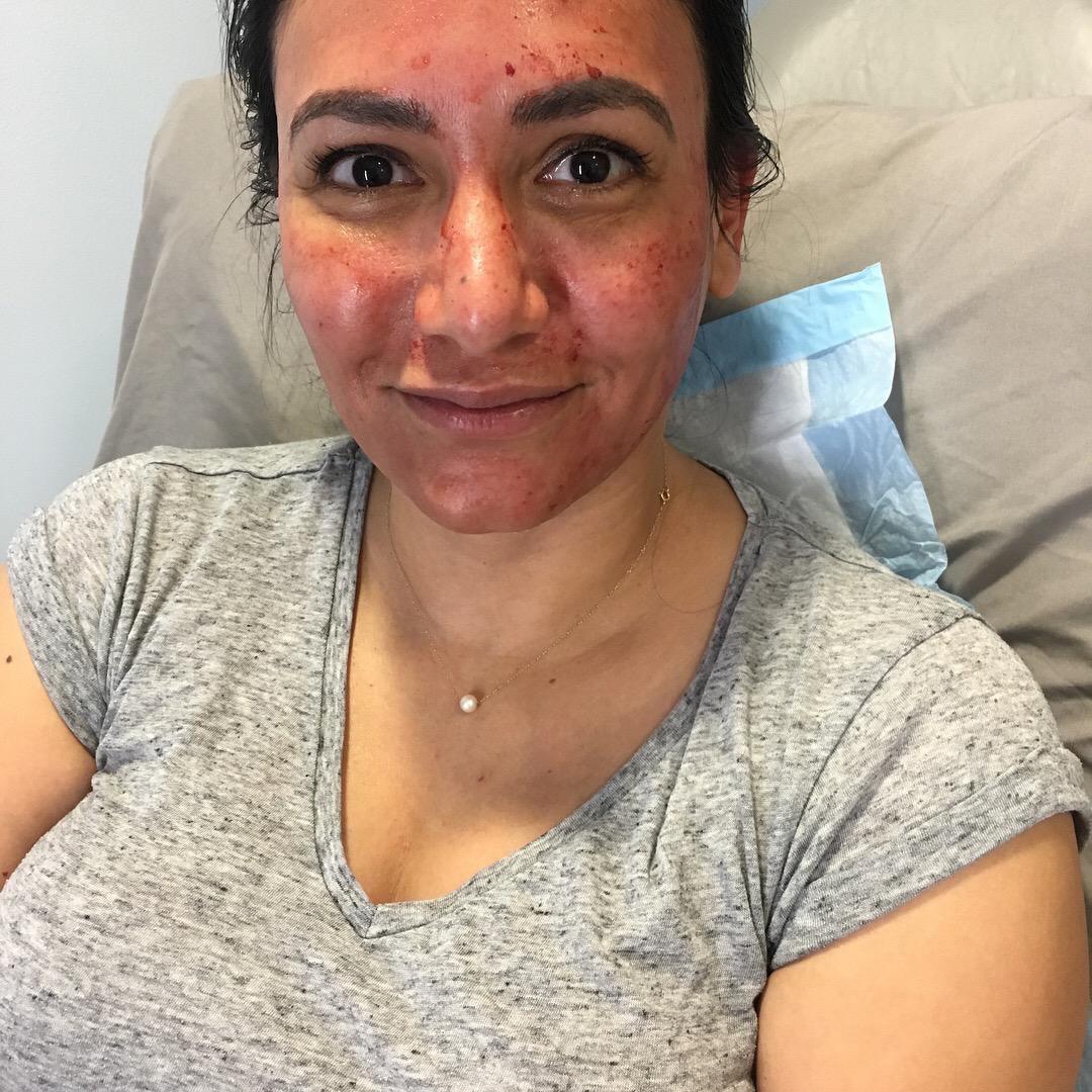 Microneedling Specialist - Chestnut Hill, MA & Natick, MA: Evolution MedSpa Boston: Medical Spa