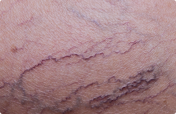 Harvard Trained Vein Doctors | Sclerotherapy Treatment for Spider and Varicose Veins | Spider and Varicose Vein Treatment Center