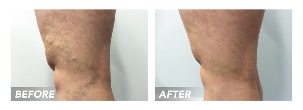 Spider Vein Treatment Houston Texas | Spider Veins Removal Near Me