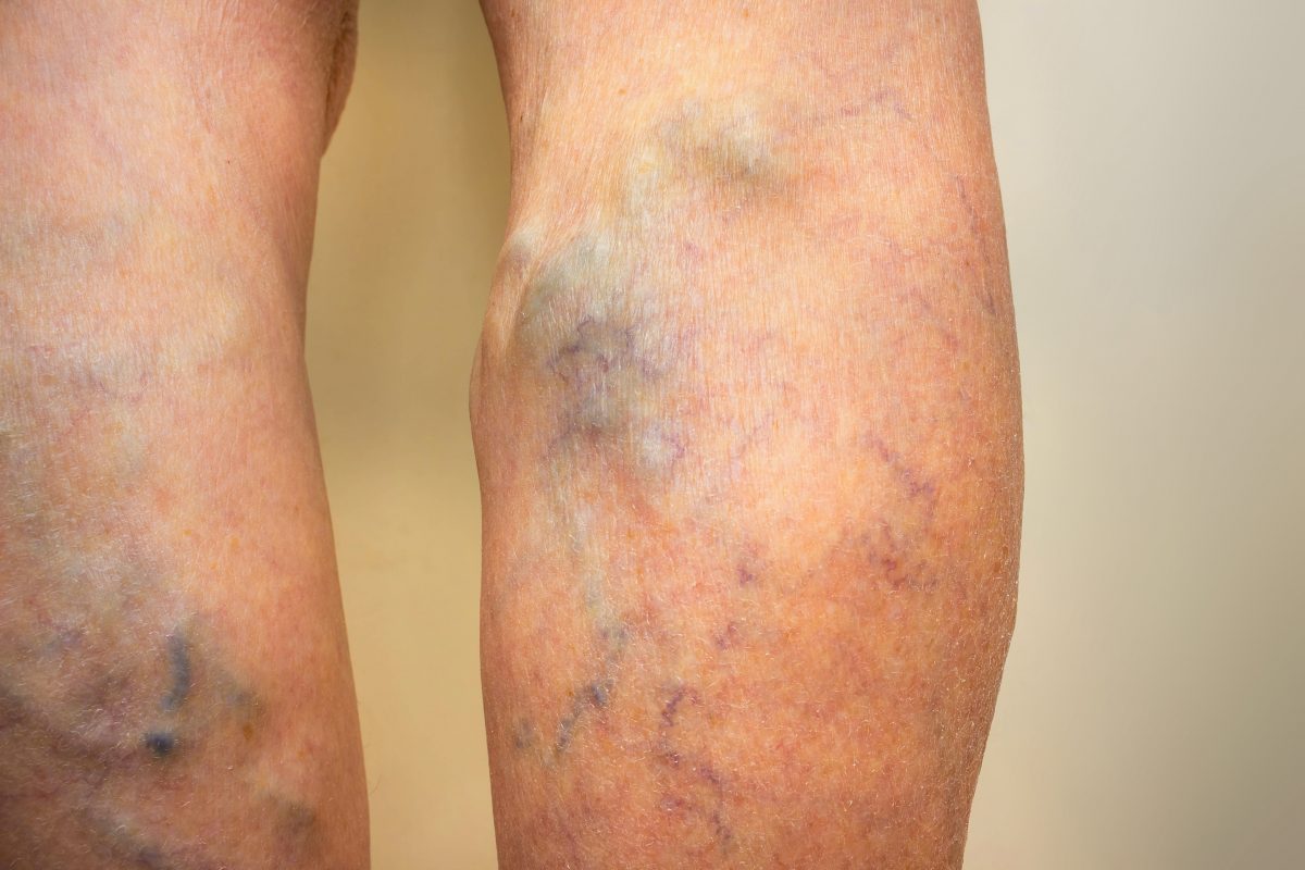 Harvard Trained Vein Doctors | Can Venous Insufficiency Be Cured? | Leg Veins Treatment Before and After