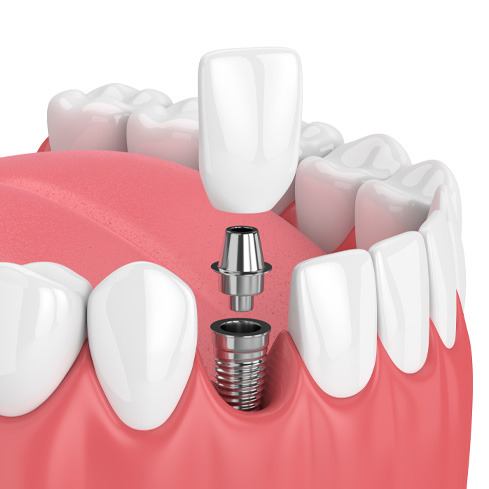 SunridgeDental  — When To Get Your Wisdom Teeth Removed?