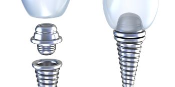 Locate A Professional Tooth Filling Up Houston Professional