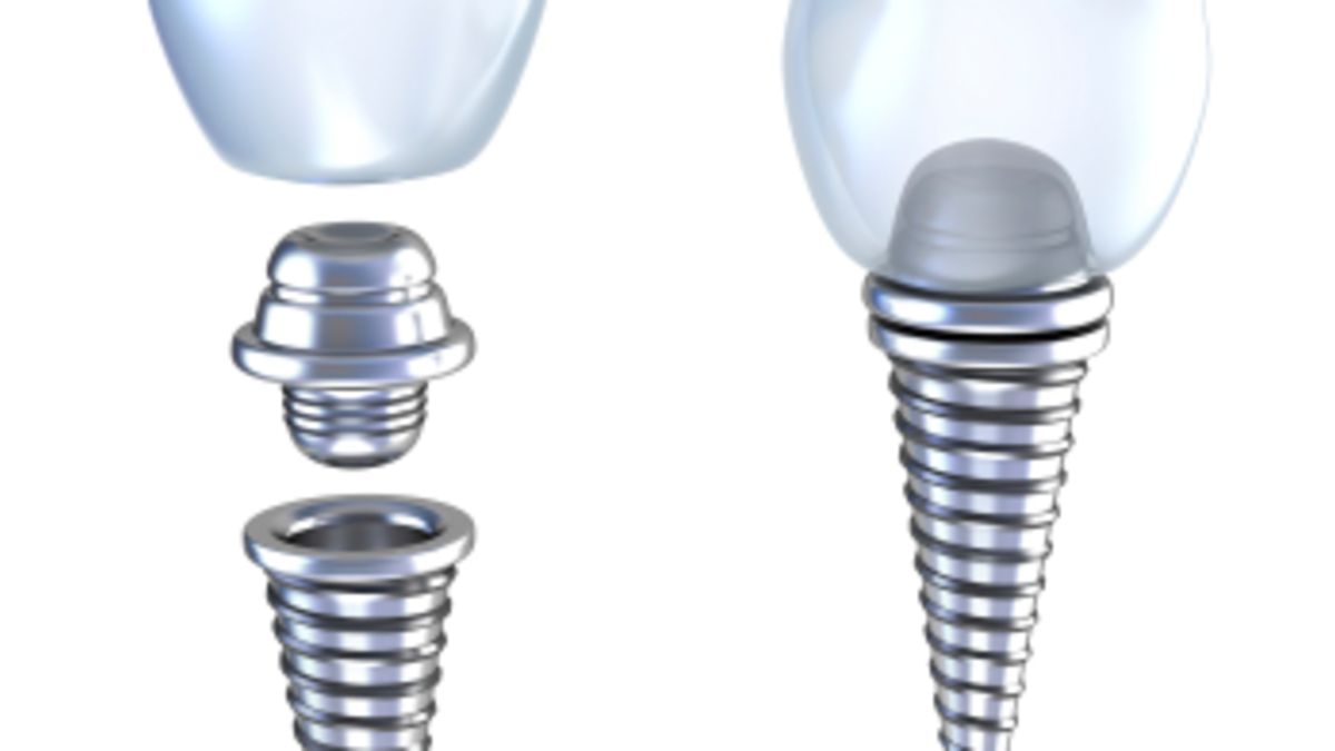 What Are The Advantages Of Composite Dental Fillings?