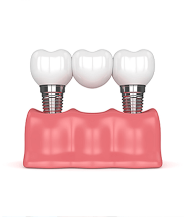 Why Choose Dental Implants? - sunridgedental.over-blog.com
