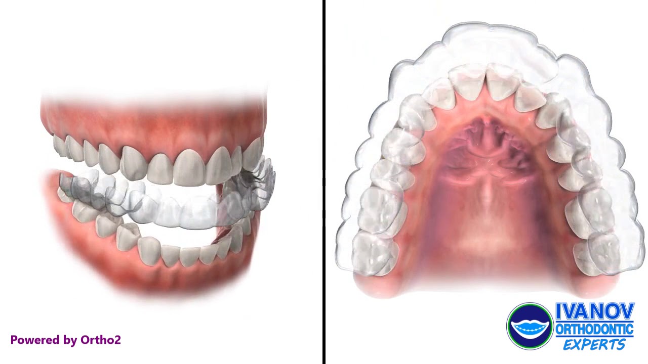 Why It Is Beneficial To Invest In Invisalign Clear Braces - jakeslessor3